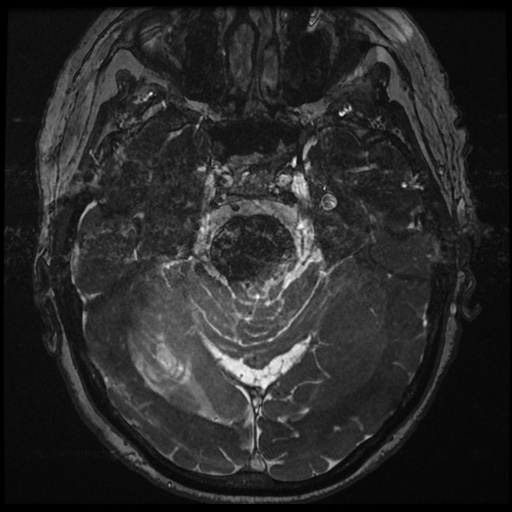 File:Balo concentric sclerosis (Radiopaedia 53875-59982 Axial T2 FIESTA 63).jpg