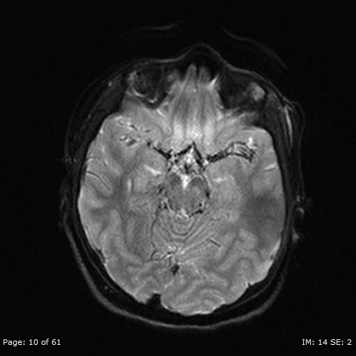 Balo concentric sclerosis (Radiopaedia 61637-69636 Axial DWI 10).jpg