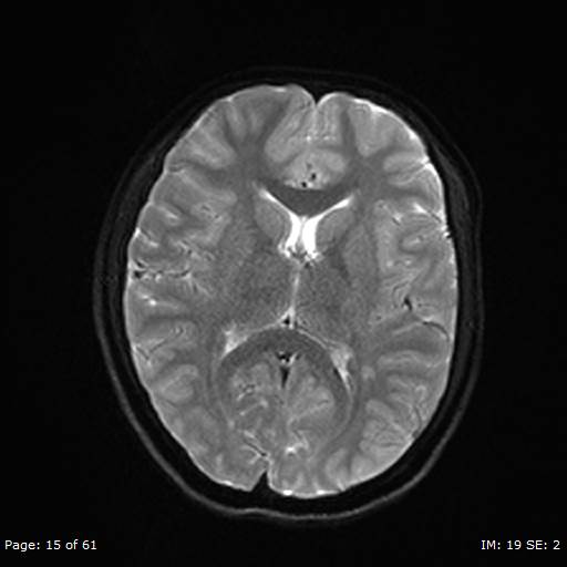 Balo concentric sclerosis (Radiopaedia 61637-69636 Axial DWI 15).jpg
