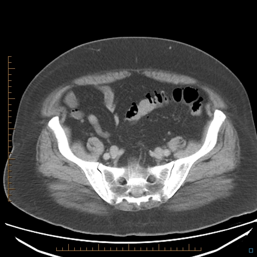 File:Bariatric balloon causing gastric outlet obstruction (Radiopaedia 54449-60672 A 33).jpg