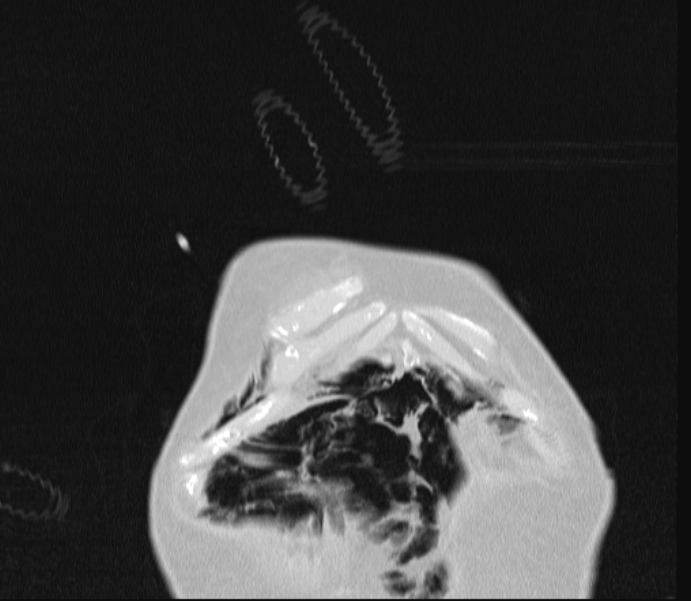 Barotrauma due to mechanical ventilation (Radiopaedia 28079-28336 Coronal lung window 7).jpg