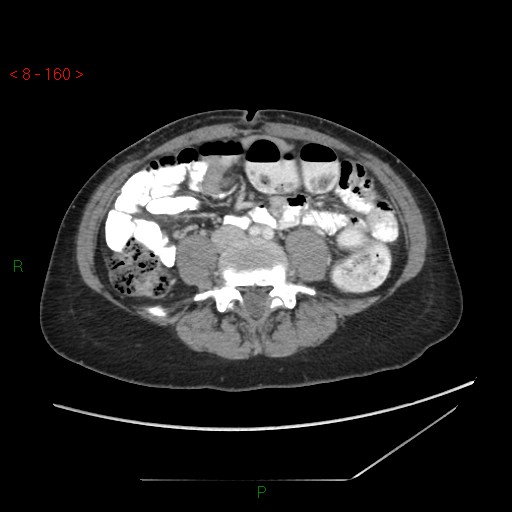 Bartholin gland cyst (Radiopaedia 54904-61181 A 40).jpg