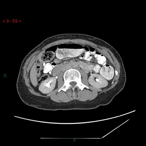 File:Bartholin gland cyst (Radiopaedia 54904-61181 Axial C+ delayed 15).jpg
