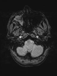 Base of skull chondrosarcoma (Radiopaedia 30410-31070 Axial SWI 7).jpg