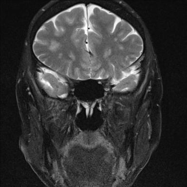 File:Base of skull chondrosarcoma (Radiopaedia 30410-31070 Coronal T2 fat sat 12).jpg