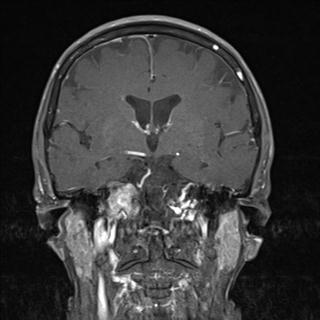 File:Base of skull chondrosarcoma (Radiopaedia 30410-31070 G 9).jpg