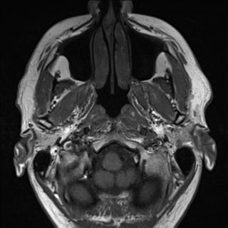 File:Base of tongue squamous cell carcinoma (Radiopaedia 31174-31884 Axial T1 33).jpg