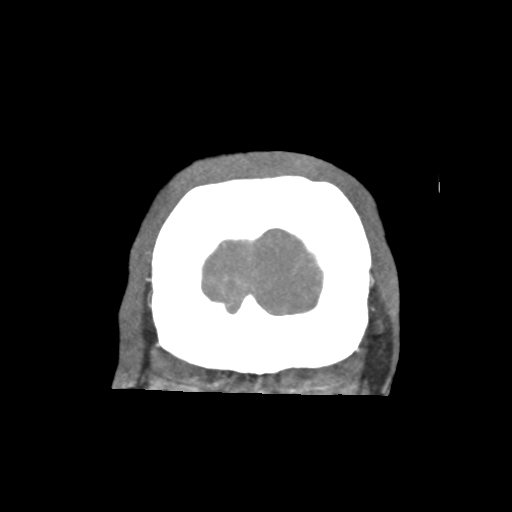 Basilar and bilateral vertebral artery occlusion (Radiopaedia 45592-49723 B 93).png
