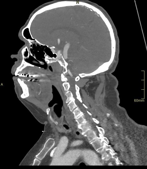 File:Basilar artery aneurysm (Radiopaedia 56261-62932 C 37).jpg