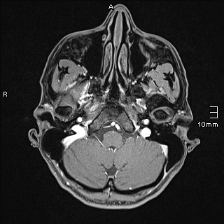 Basilar artery perforator aneurysm (Radiopaedia 82455-99523 G 13).jpg