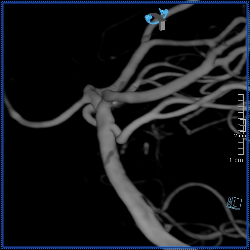 Basilar artery perforator aneurysm (Radiopaedia 82455-99524 3D Left VA 26).jpg