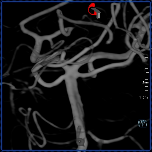 Basilar artery perforator aneurysm (Radiopaedia 82455-99524 3D Left VA 5).jpg