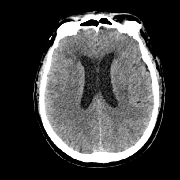 Basilar artery thrombosis (Radiopaedia 53351-59352 Axial non-contrast 73).jpg
