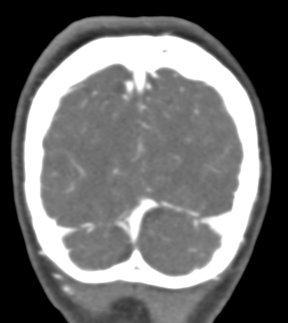 File:Basilar tip aneurysm with coiling (Radiopaedia 53912-60086 B 142).jpg