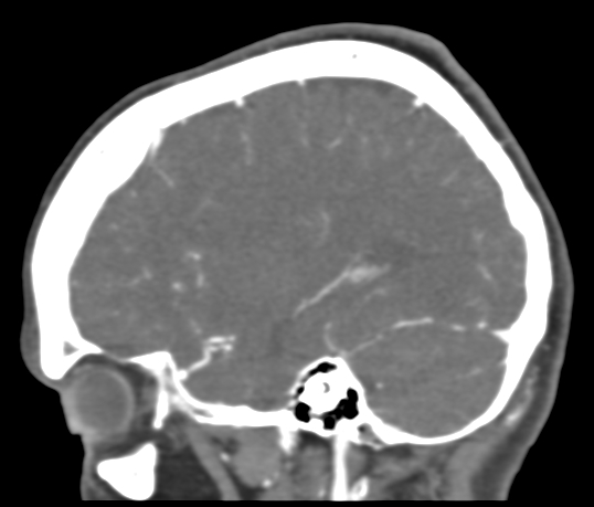 Basilar tip aneurysm with coiling (Radiopaedia 53912-60086 C 99).jpg