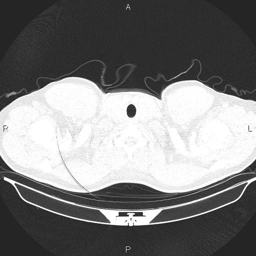File:Beam hardening and ring artifacts (Radiopaedia 85323-100915 Axial lung window 2).jpg