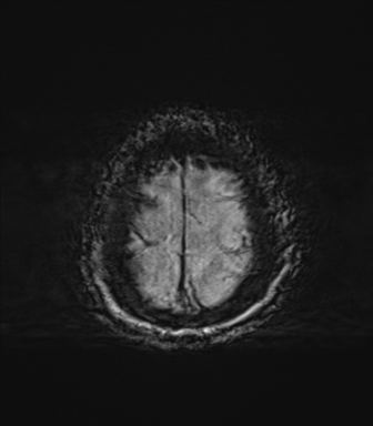 File:Behavioral variant frontotemporal dementia and late onset schizophrenia (Radiopaedia 52197-58083 Axial SWI 74).png