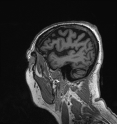 Behavioral variant frontotemporal dementia and late onset schizophrenia (Radiopaedia 52197-58083 Sagittal T1 92).png