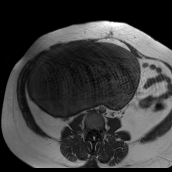 File:Benign seromucinous cystadenoma of the ovary (Radiopaedia 71065-81300 Axial T1 23).jpg