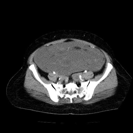 Benign spindle cell tumor - abdominopelvic (Radiopaedia 61300-69212 A 47).jpg