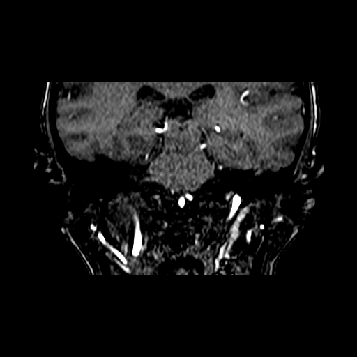 File:Berry aneurysm of the terminal internal carotid artery (Radiopaedia 88286-104918 Coronal TOF 63).jpg