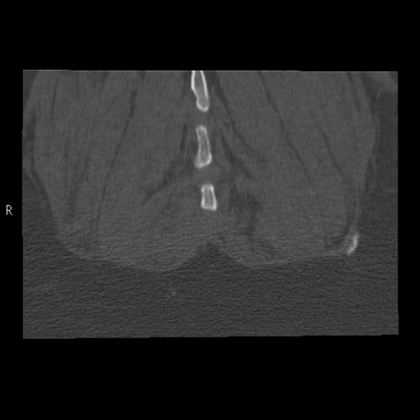 Bertolotti syndrome (Radiopaedia 24864-25128 Coronal bone window 52).jpg