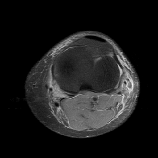 File:Biceps femoris distal tendon avulsion (Radiopaedia 15109-14987 Axial PD fat sat 18).jpg