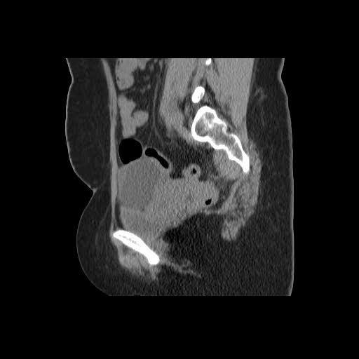File:Bicornuate uterus- on MRI (Radiopaedia 49206-54296 A 14).jpg