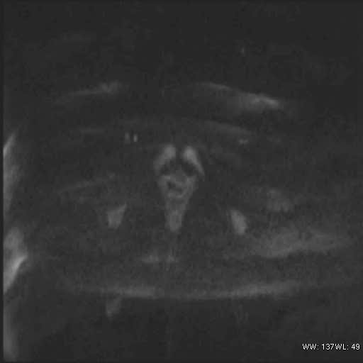 File:Bicornuate uterus (MRI) (Radiopaedia 49206-54297 Axial 111).jpg