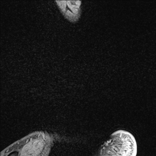 File:Bilateral Achilles tendon complete tear (Radiopaedia 81344-95051 Sagittal WE - Left 9).jpg