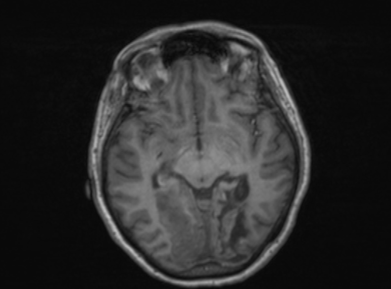 Bilateral PCA territory infarction - different ages (Radiopaedia 46200-51784 Axial T1 256).jpg