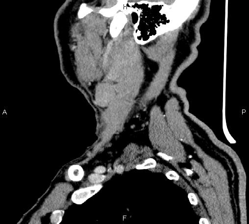 Bilateral Warthin tumors (Radiopaedia 84034-99263 D 23).jpg