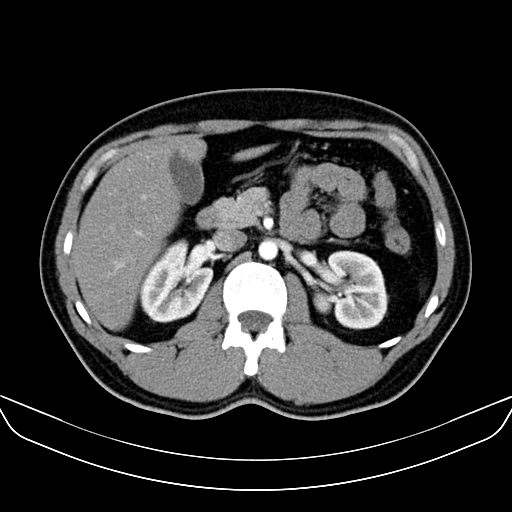 File:Bilateral accessory renal arteries with mild pelvi-ureteric junction (PUJ) obstruction (Radiopaedia 66357-75596 A 20).jpg