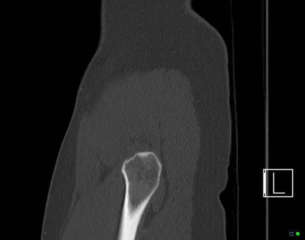 File:Bilateral acetabular fractures (Radiopaedia 79272-92308 Sagittal bone window 5).jpg