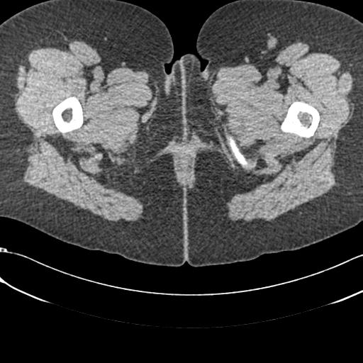 File:Bilateral acetabular protrusion with pincer type femoro-acetabular impingement (Radiopaedia 30134-30733 AXIAL SOFT THIN 119).jpg
