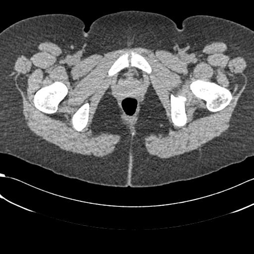 Bilateral acetabular protrusion with pincer type femoro-acetabular impingement (Radiopaedia 30134-30733 AXIAL SOFT THIN 76).jpg