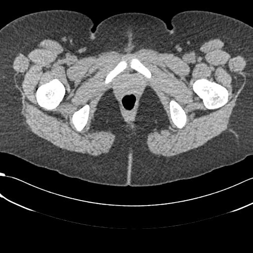 Bilateral acetabular protrusion with pincer type femoro-acetabular impingement (Radiopaedia 30134-30733 AXIAL SOFT THIN 85).jpg
