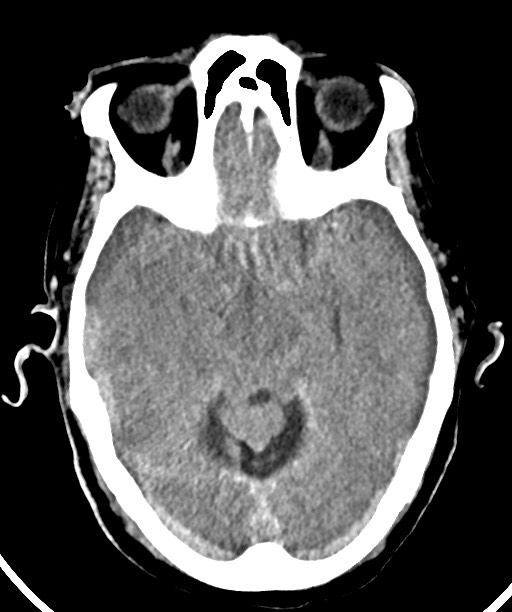 Bilateral acute on chronic subdural hematomas (Radiopaedia 78466-91146 Axial non-contrast 24).jpg