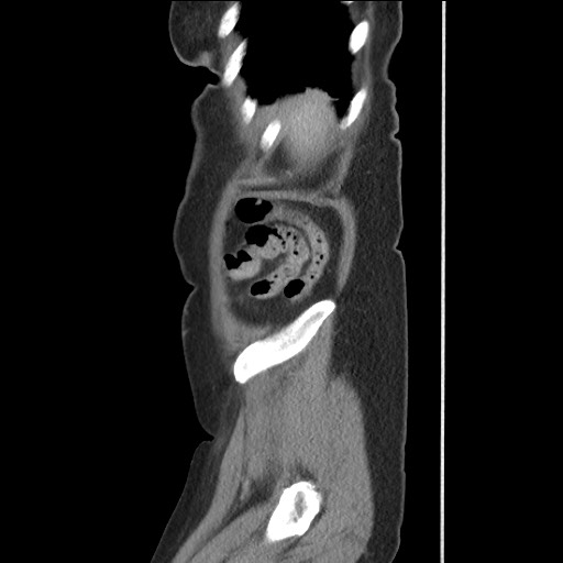 Bilateral adrenal granulocytic sarcomas (chloromas) (Radiopaedia 78375-91007 C 121).jpg