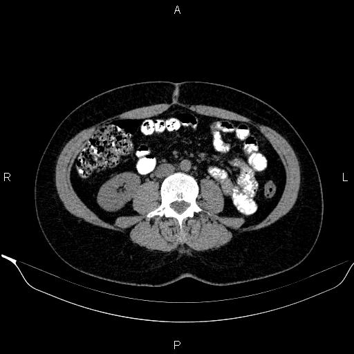 File:Bilateral adrenal myelolipoma (Radiopaedia 63058-71535 Axial non-contrast 97).jpg