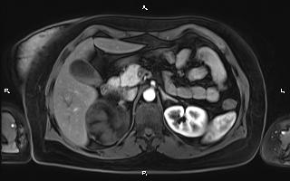 Bilateral adrenal myelolipoma (Radiopaedia 63058-71537 Axial T1 C+ fat sat 38).jpg