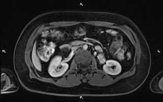 Bilateral adrenal myelolipoma (Radiopaedia 63058-71537 G 50).jpg