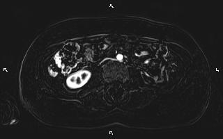 Bilateral adrenal myelolipoma (Radiopaedia 63058-71537 I 64).jpg