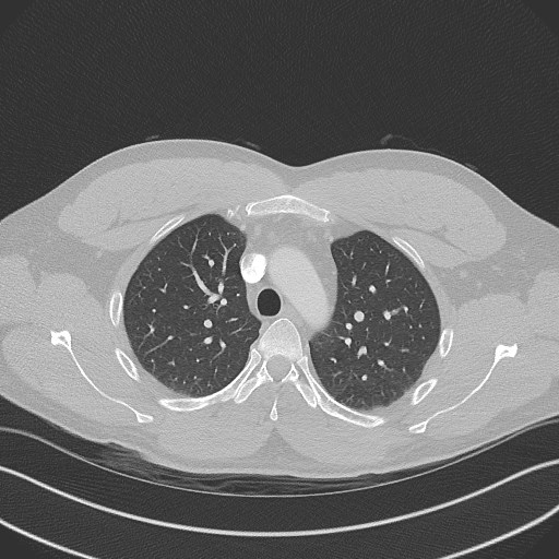 Bilateral atelectasis (Radiopaedia 48666-53675 Axial lung window 30).jpg