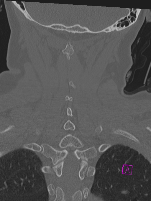Bilateral atlanto-occipital assimilation (Radiopaedia 28350-28603 Coronal bone window 37).jpg