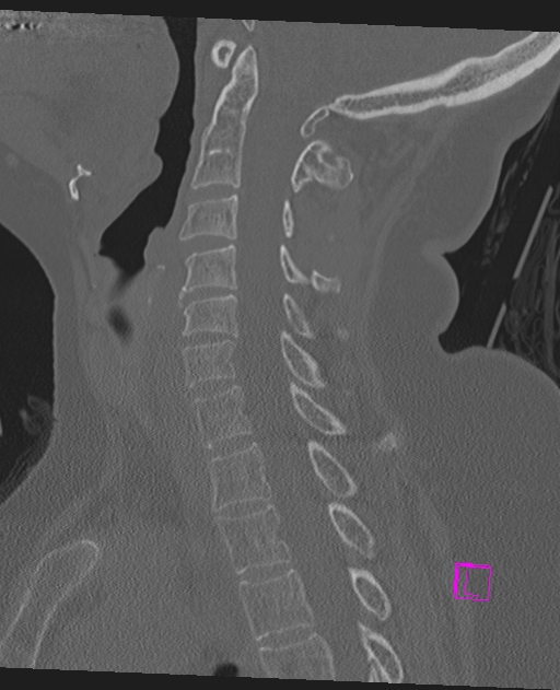 Bilateral atlanto-occipital assimilation (Radiopaedia 28350-28603 Sagittal bone window 38).jpg