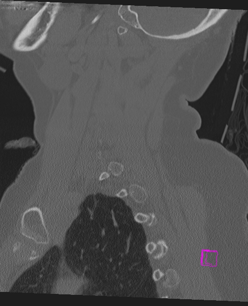 Bilateral atlanto-occipital assimilation (Radiopaedia 28350-28603 Sagittal bone window 60).jpg