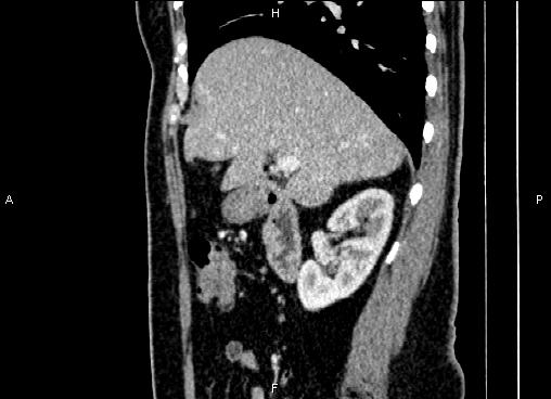 Bilateral benign adrenal adenomas (Radiopaedia 86912-103124 E 32).jpg