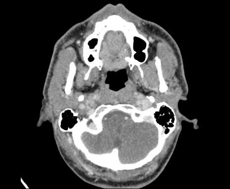 Bilateral carotid body tumors (Radiopaedia 61841-69870 Axial Post contrast 13).jpg