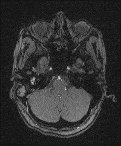 File:Bilateral carotid body tumors and right jugular paraganglioma (Radiopaedia 20024-20060 Axial 153).jpg